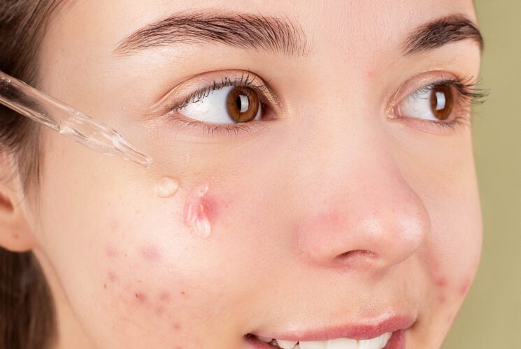 Traiter l’acné naturellement